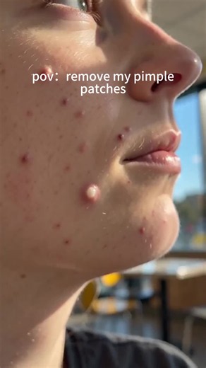 Best Pimple Patch Tips: How to Use Hydrocolloid Patches for Acne