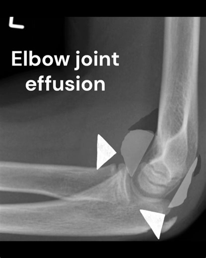 Elbow joint effusion