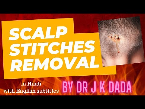 DIY Painless Stitches Removal - At Home!