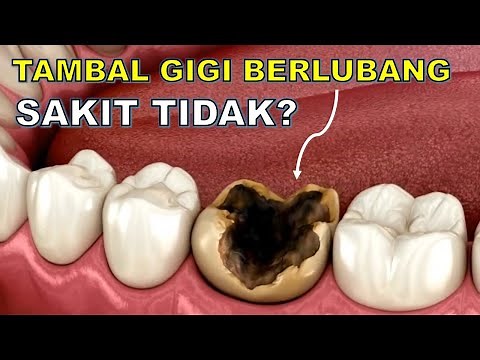 Does filling a cavity hurt?