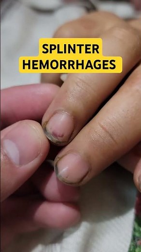 Infective Endocarditis | Splinter Hemorrhages #infectiveendocarditis #Endocarditis ##splinter