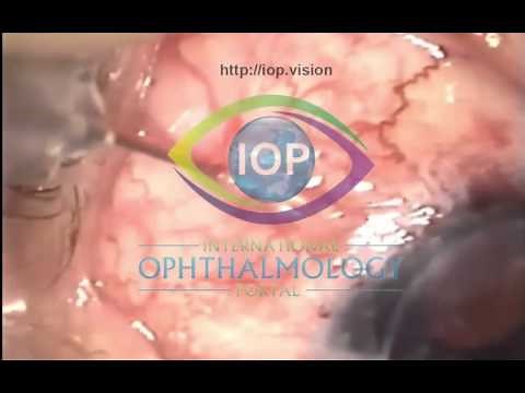 Bleb Needling Advanced Preview