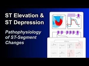 ST Elevation & Depression - What Causes It?