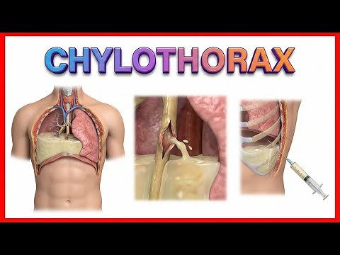 Chylothorax Animation : Etiology, Clinical features, Complications and Diagnosis / USMLE