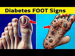 8 Signs Your Feet Tell You About Diabetes Complications!