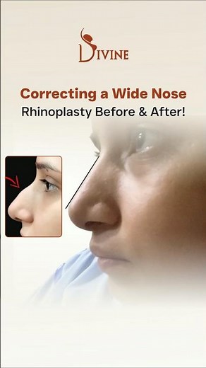 Correcting a Wide Nose - Rhinoplasty Before & After | On-Table Nose Reshaping