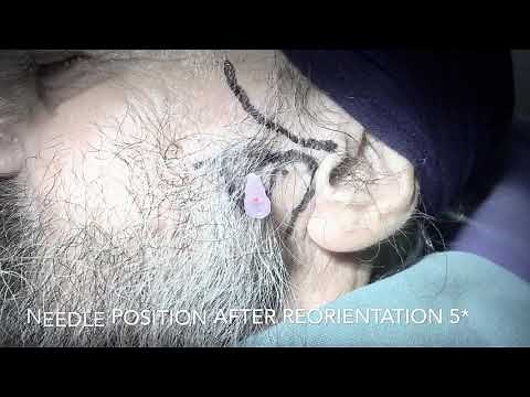 Extra oral mandibular nerve block with Absolute Injection for Trigeminal Neuralgia