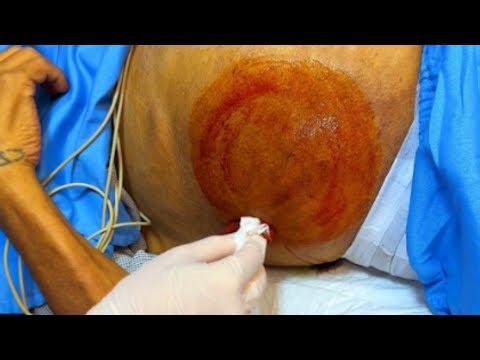 A_Drain_8L_Ascites_-_HIGH-RISK_Jaundice_Patient(720p) #healthtips ‎