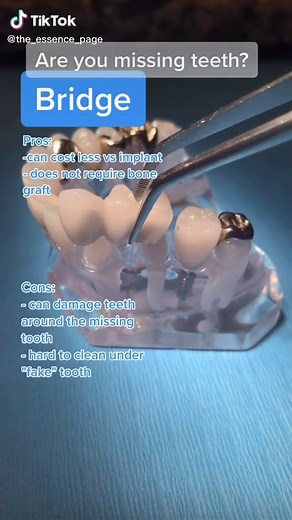 Missing Teeth? Bridge vs Implant - Costs and Comparisons