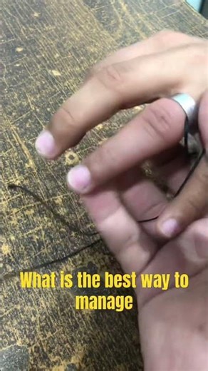 Ring Tourniquet what is the best way to manage #shorts