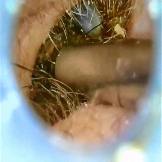 Best Ear Wax Removal | Pimple Popping, Cyst and Blackhead