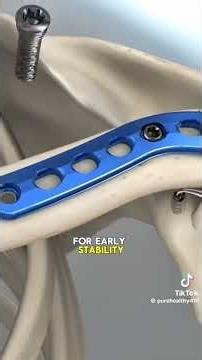 # Distal Clavicle fracture fixation