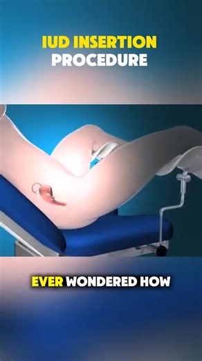 IUD Insertion Procedure: What You Need to Know #iudinsertion #IUD #birthcontrol #contraception #Gynaecology | PurelyFit
