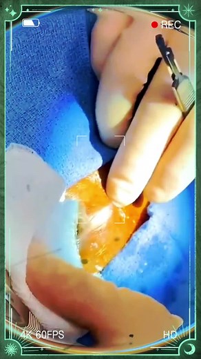 Relaxing Inflamed Pimple Extraction | Pimple Popping Videos