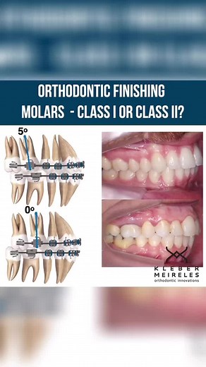 Upper Premolar Extraction and Molar Tube Selection in Orthodontics