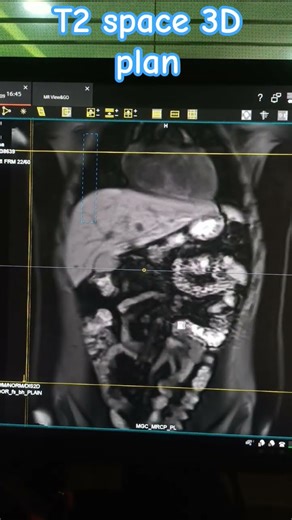 #mri #techlearner #mrimachine #mrimaster #cardiacmri #anatomy