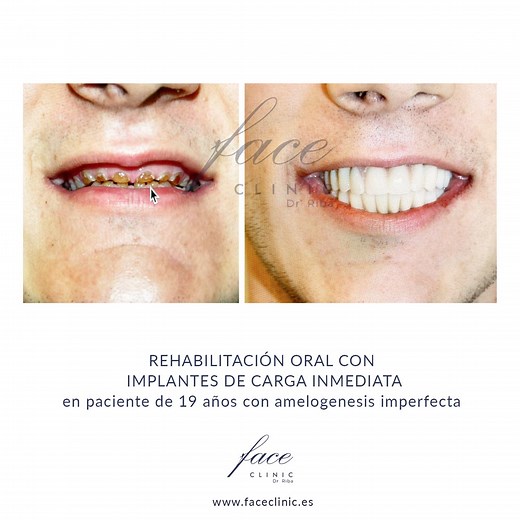 Amelogénesis imperfecta: qué es, causas y tratamiento - Face Clinic