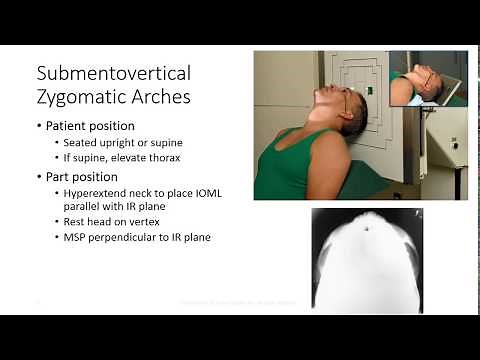 Radiographic Positioning of the Zygomatic Arches