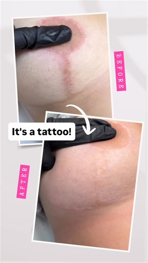 Paramedical Tattoo Artist on Instagram: "After 4 sessions, this client is extremely happy with her surgical scars! I used my ink modifiers to ensure that her ink didn't oxidize yellow/orange overtime. Not all paramedical tattoo artists are created equal. I have spent years and invested into numerous trainings to make sure that my clients get beautiful long lasting results. #paramedicaltattoo #camouflagetattoo #scartreatment #scarremoval #scartattoo"