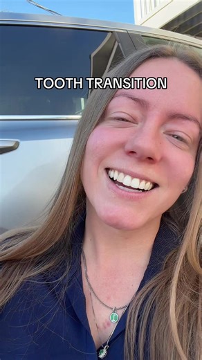 millennial ass transition i’m sorry i suck LOOK AT MY BEAUTIFUL TOOTH LOL #bonding #dentistry it’s just a #temporaryfix
