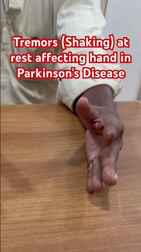 Resting tremors (Shaking) affecting left hand in a person with Parkinson’s disease