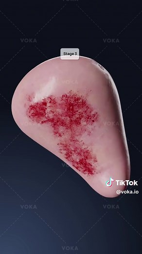 Understanding Adenomyosis: Symptoms and Treatment Options