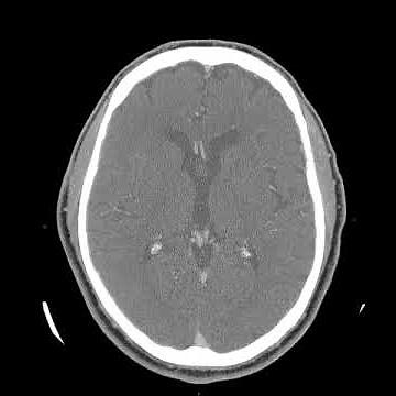 Axial CT Scan: elongated and tortuous basilar artery