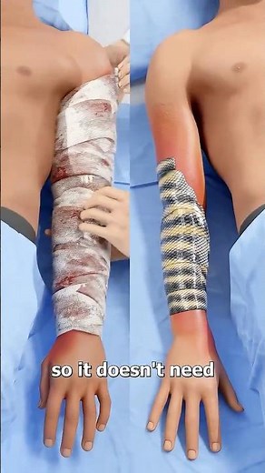 Why Burn Victims are Using Fish Skin Grafts 🚑 #shorts #humanbodyfacts #science