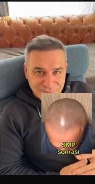 Saç pigmentasyonundan sonra saç ekimi yapılır mı?