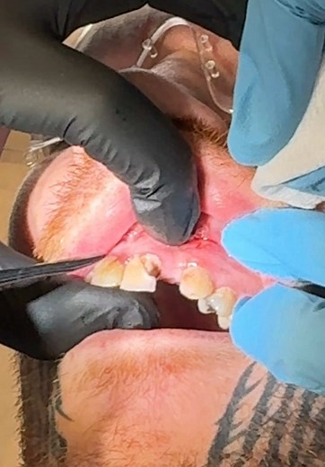 Central Incisor Extraction: Oral Surgery Explained