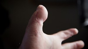 2.2K views · 34 reactions | James Eisel received a new thumb in the form of his big toe after suffering a severe injury from burning wood with high-voltage electricity. Dr. Harvey Chim and his team of problem solvers at the UF Health Plastic Surgery and Aesthetics Center successfully restored the function to both of his hands, giving James a second chance. | UF Health | Facebook