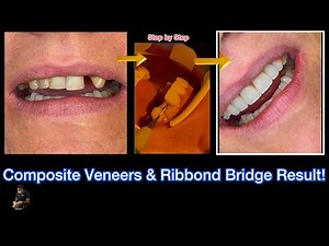Composite Veneers & Ribbond Bridge | Advanced Aesthetic Dentistry on Upper Anteriors