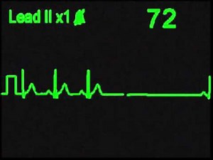 Sinus Exit Block - ECG Simulator - Arrhythmia Simulator