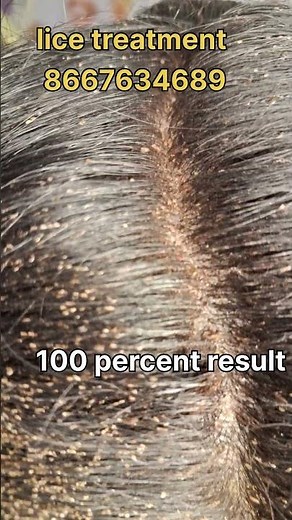 How to remove nits and lice #hair #haircare#lice#nits#hairstyle #eeru #coimbatore #peenu#hairclean