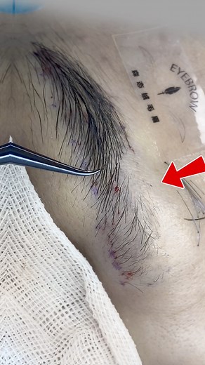 151K views · 826 reactions | #eyebrowtransplantation #eyebrowtrimming...
