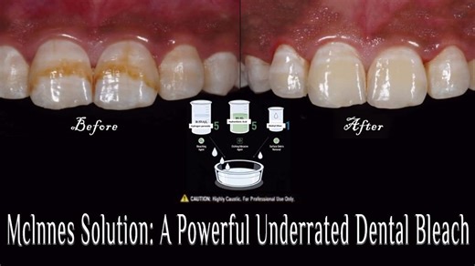 Mclnnes Solution: A Powerful Underrated Dental Bleaching Formula 
