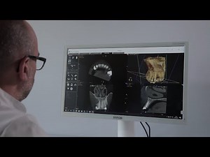CS 9600 CBCT System – CS MAR with unique live comparison tool