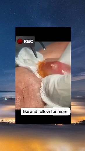 Satisfying Pimple Cyst Popping Exploration Videos
