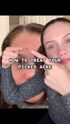 Healing Picked Acne: Tips and Solutions