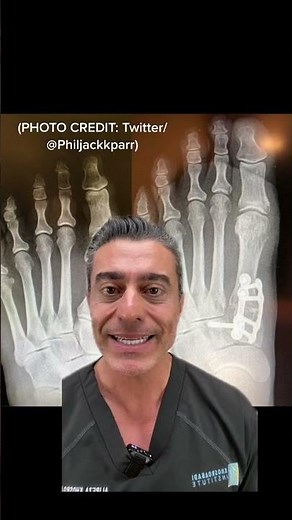 What is Lapiplasty? 3D Bunion Surgery?