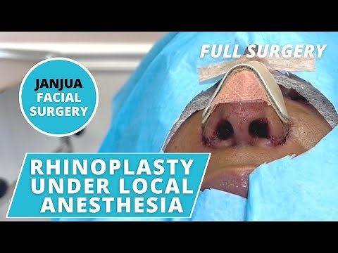 RHINOPLASTY UNDER LOCAL ANESTHESIA - DR. TANVEER JANJUA - NEW JERSEY