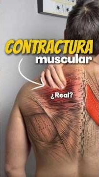 Do muscle contractures exist?