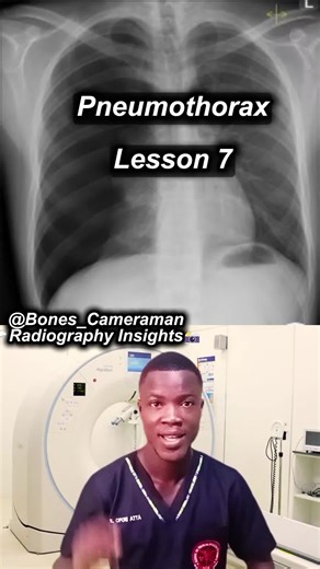 “Air around the lung causes collapse, called pneumothorax. On chest X-ray, you’ll see a visible lung edge and no lung markings beyond it. Learn the pattern. Don’t guess the diagnosis. #radiographystudent #medicalimaging #Radiography #chest #medicalstudent
