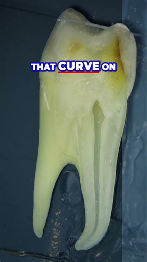 Unlock Perfect Root Canals Rotary File Secrets & Expert Tips!