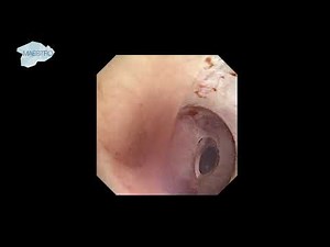 ECIRS Puncture