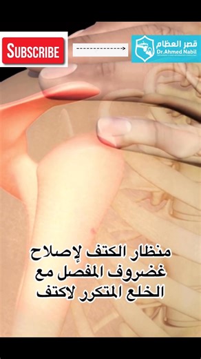 👌تمزق الشفا الحُقّاني (labrum tear) :- 🙈هو تمزق في الحلقة الغضروفية التي تحيط بمفصل الكتف، وهو سبب شائع للخلع المتكرر، خاصة الخلع الأمامي. تحدث هذه الإصابة عندما يدفع رأس عظم العضد الشفا، مسبباً عدم ثبات المفصل ويزيد من احتمالية تكرار الخلع في المستقبل. يعتمد العلاج على شدة التمزق ويشمل في البداية العلاج الطبيعي، وقد يحتاج إلى جراحة لإعادة تثبيت الشفا الممزق في حال تكرار الخلع أو عدم التحسن . 🙈ما هو الشفا الحُقّاني (Labrum)؟ 🙈الشفا هو حلقة من النسيج الضام الليفي التي تحيط بالحافة العظمية لتج