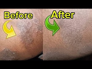 7 reasons your FUNGI hasn’t gone permanently |Pharmacist reveals HIDDEN tips!