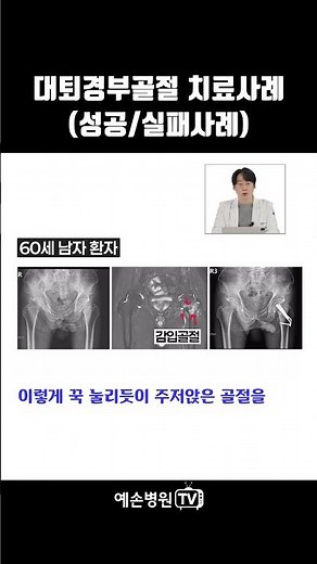 Treatment of Femoral Neck Fractures (Hip Fractures): Success and Failure Cases