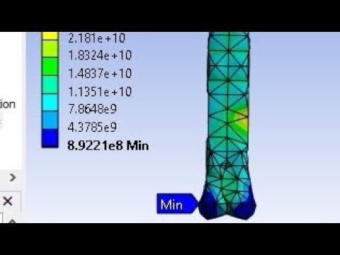 Biomechanal FEA Simulation of Femur bone of human Knee joint by Solidworks and ANSYS