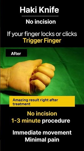 [#short ]Left Middle Finger LOCKED? Instant Trigger Finger Fix (No Incision) #triggerfinger